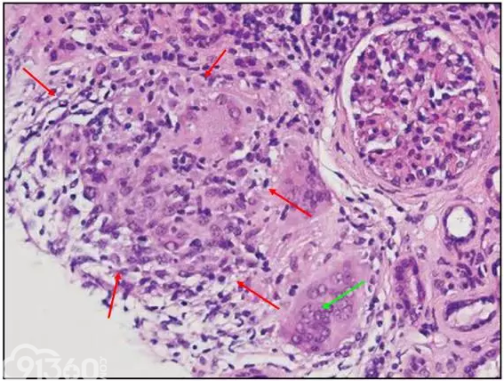 肾内病理图解：小管间质性肾炎