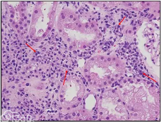 肾内病理图解：小管间质性肾炎