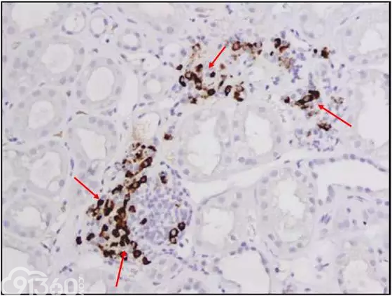 肾内病理图解：小管间质性肾炎