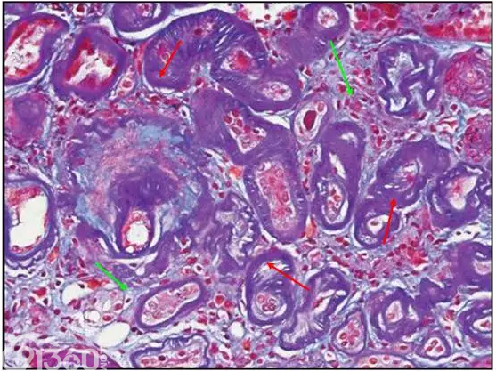 肾内病理图解：小管间质性肾炎