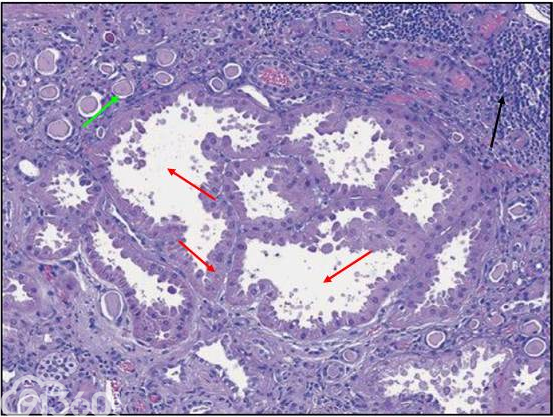 肾内病理图解：小管间质性肾炎