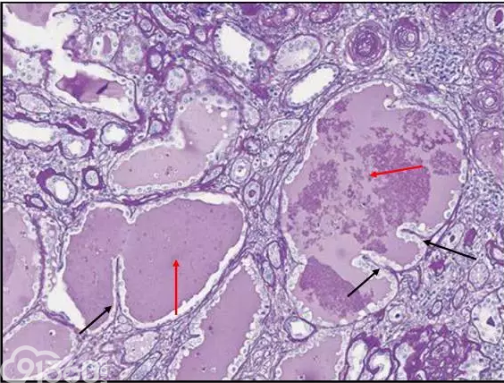 肾内病理图解：小管间质性肾炎