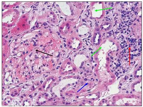 肾内病理图解：小管间质性肾炎