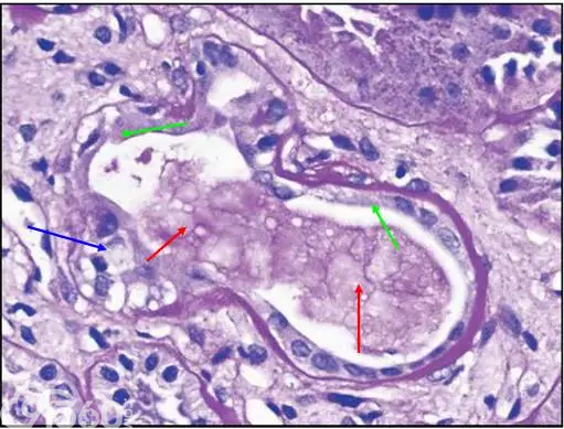 肾内病理图解：小管间质性肾炎