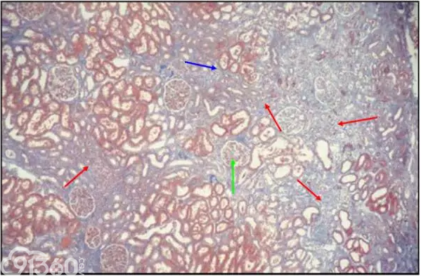 肾内病理图解：小管间质性肾炎