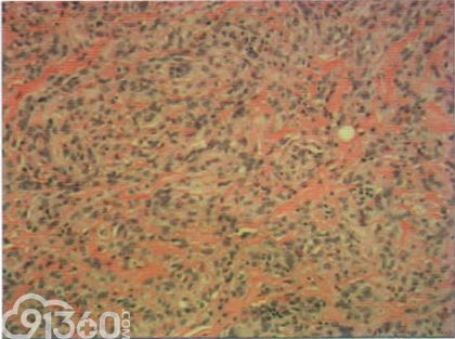 图1外阴血管肌纤维母细胞瘤病理切片(HEX200)