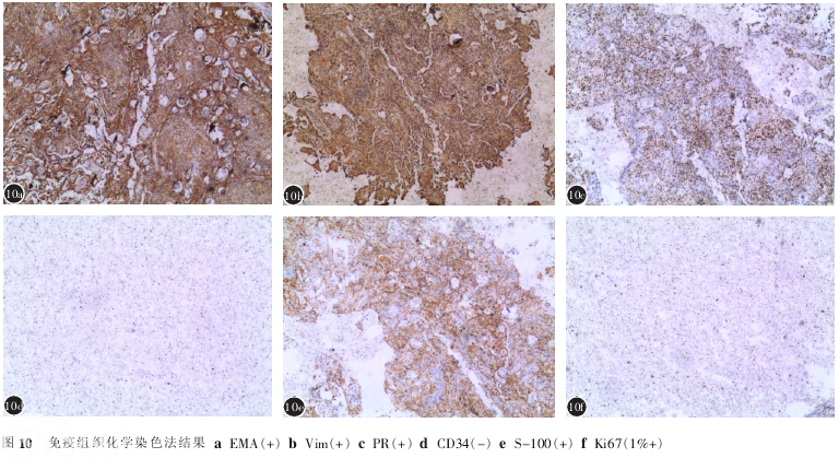 病理学报告:脊膜瘤钙化,可见砂粒体,内皮细胞型whoⅠ级(图8,9).