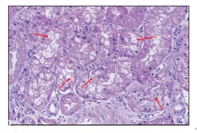 肾内病理图解：缺血性和毒性急性肾小管损伤