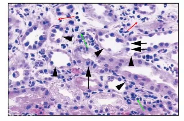 肾内病理图解：缺血性和毒性急性肾小管损伤