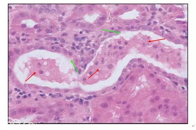 肾内病理图解：缺血性和毒性急性肾小管损伤