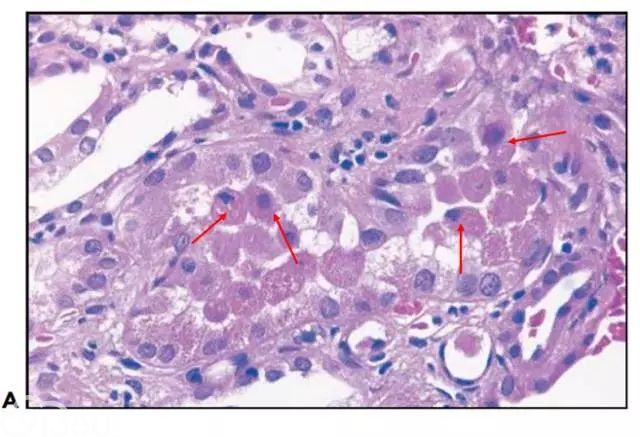 肾内病理图解：缺血性和毒性急性肾小管损伤