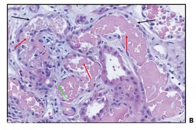 肾内病理图解：缺血性和毒性急性肾小管损伤