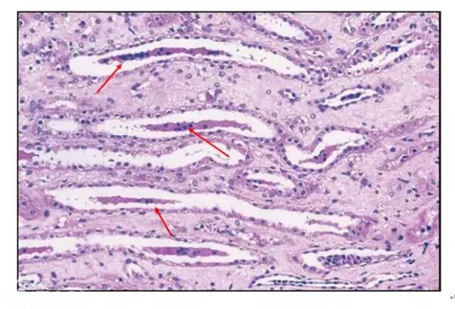 肾内病理图解：缺血性和毒性急性肾小管损伤