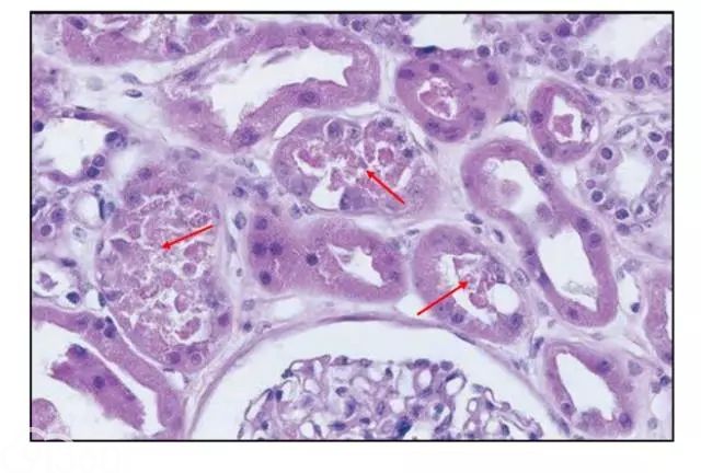 肾内病理图解：缺血性和毒性急性肾小管损伤