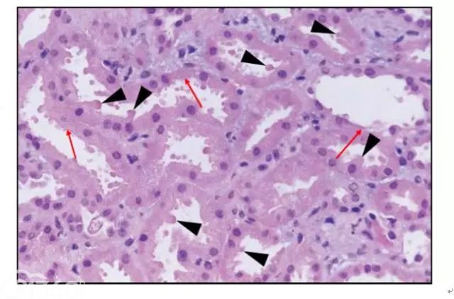 肾内病理图解：缺血性和毒性急性肾小管损伤