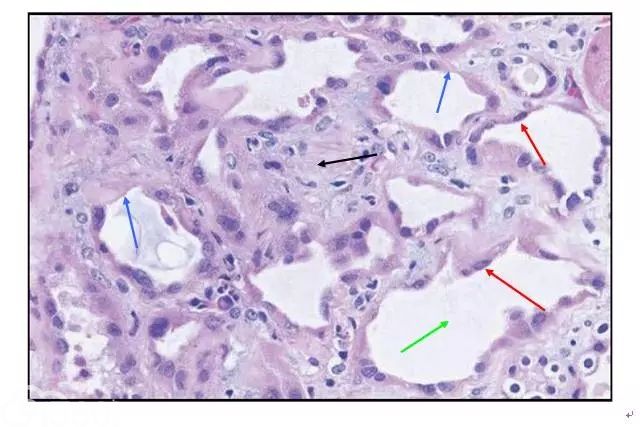 肾内病理图解：缺血性和毒性急性肾小管损伤