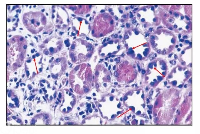 肾内病理图解：缺血性和毒性急性肾小管损伤