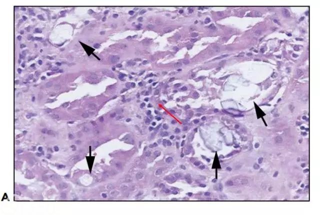 肾内病理图解：缺血性和毒性急性肾小管损伤
