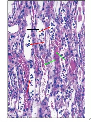 肾内病理图解：缺血性和毒性急性肾小管损伤