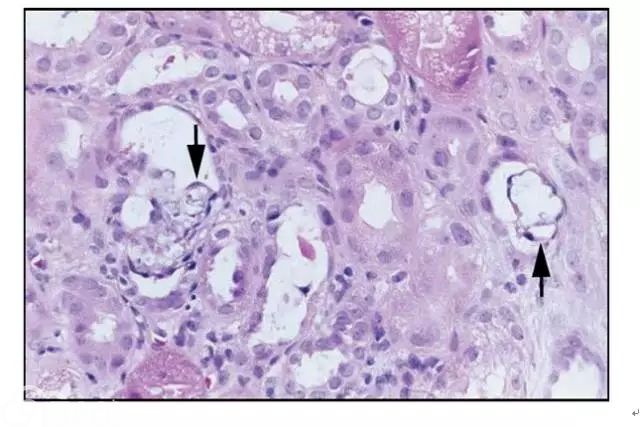 肾内病理图解：缺血性和毒性急性肾小管损伤
