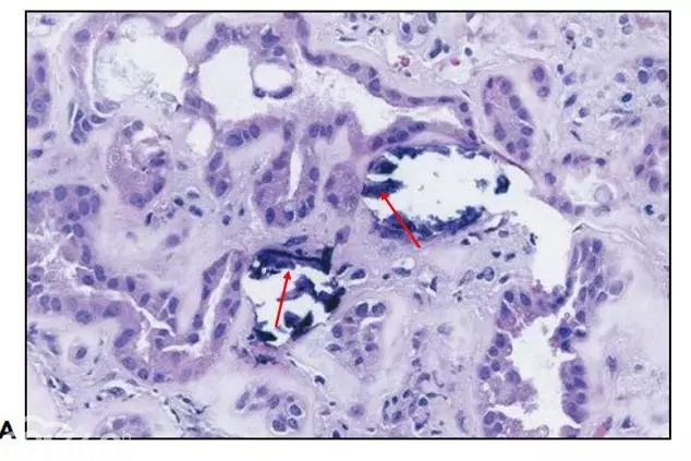 肾内病理图解：缺血性和毒性急性肾小管损伤