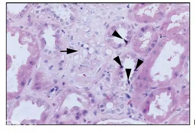 肾内病理图解：缺血性和毒性急性肾小管损伤