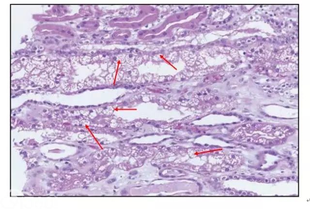 肾内病理图解：缺血性和毒性急性肾小管损伤