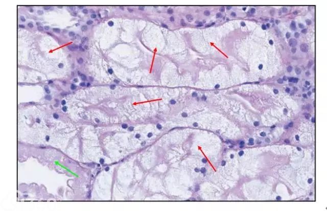 肾内病理图解：缺血性和毒性急性肾小管损伤