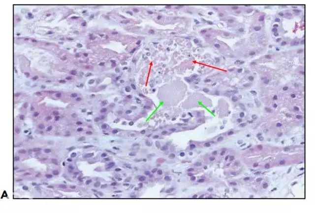 肾内病理图解：缺血性和毒性急性肾小管损伤
