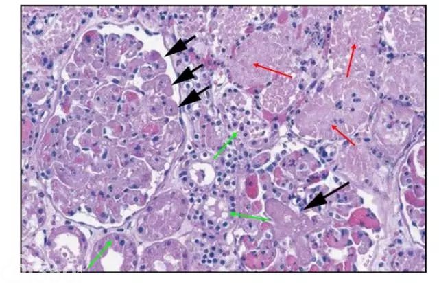 肾内病理图解：缺血性和毒性急性肾小管损伤