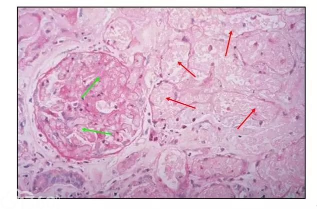 肾内病理图解：缺血性和毒性急性肾小管损伤
