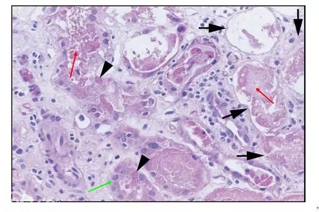 肾内病理图解:缺血性和毒性急性肾小管损伤
