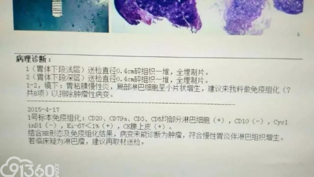 一文看懂胃镜活检病理报告