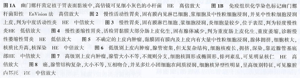 慢性胃炎及上皮肿瘤胃粘膜活检病理诊断共识