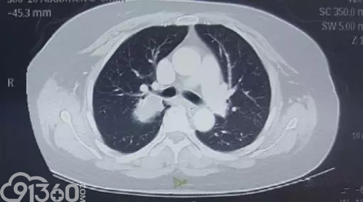 64岁女性患直肠癌肺转移入院治疗病例分析