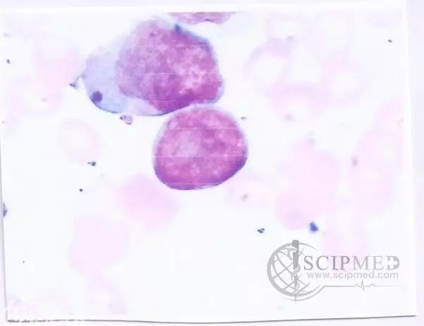 67岁男性患骨髓增生异常综合征-环形铁幼粒红细胞难治性贫血入院治疗病例分析