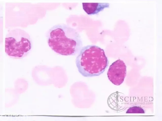 67岁男性患骨髓增生异常综合征-环形铁幼粒红细胞难治性贫血入院治疗病例分析