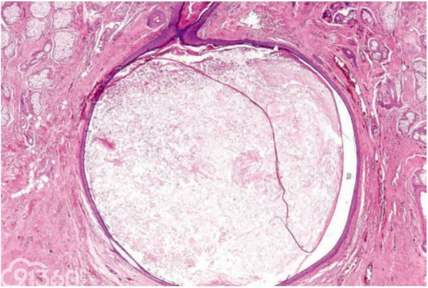 表皮样囊肿病理表现：真皮孤立性囊肿