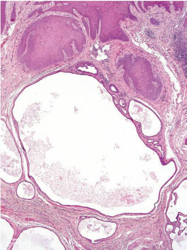 大汗腺汗囊瘤：多房性囊肿