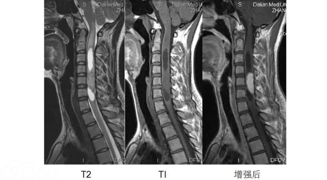 23岁女性患脊髓内神经鞘瘤入院治疗病例分析