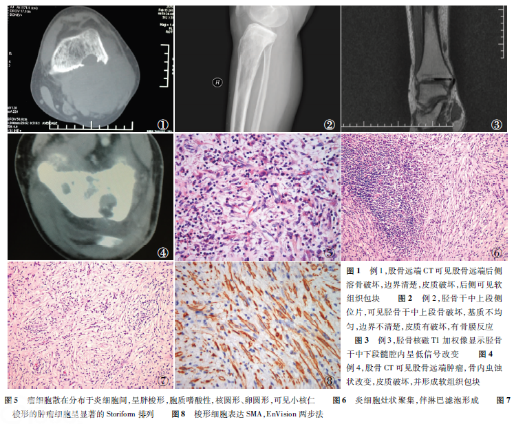 长骨炎症性肌纤维母细胞性肿瘤的临床病理观察