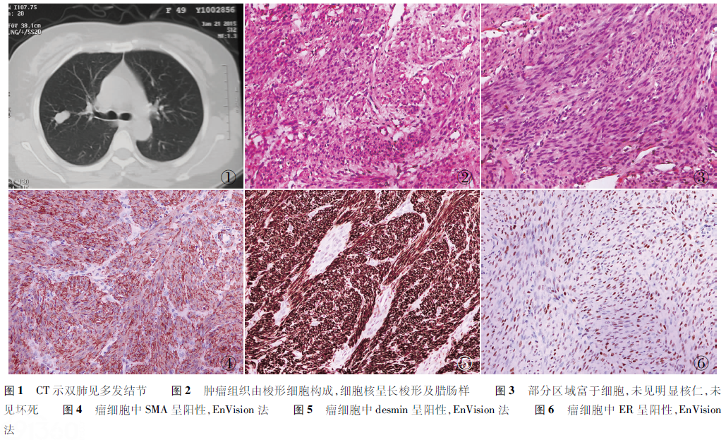 良性转移性平滑肌瘤6例临床病理分析