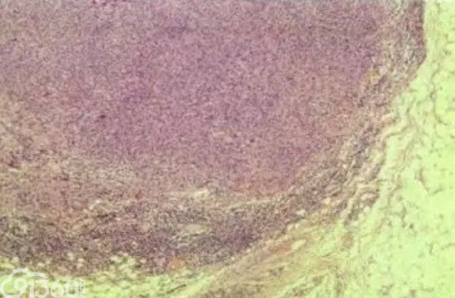 图5 实性型血管瘤样纤维组织细胞瘤