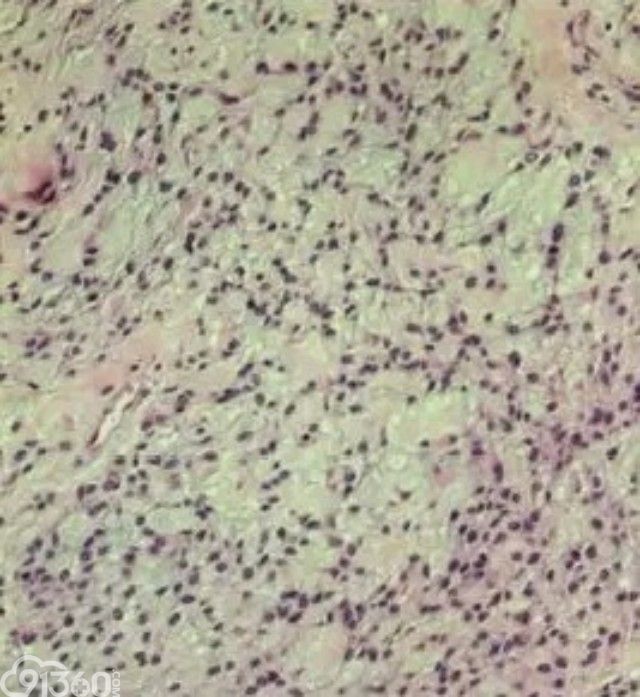 图7 骨外黏液性软骨肉瘤