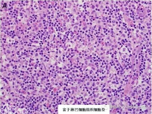 儿童系统性ebv阳性t细胞淋巴组织增殖性疾病和种痘水疱病样t细胞淋巴