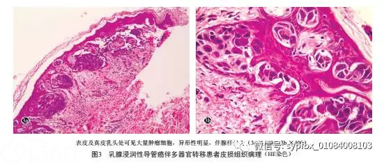 【病例报告】乳腺浸润性导管癌伴多器官转移