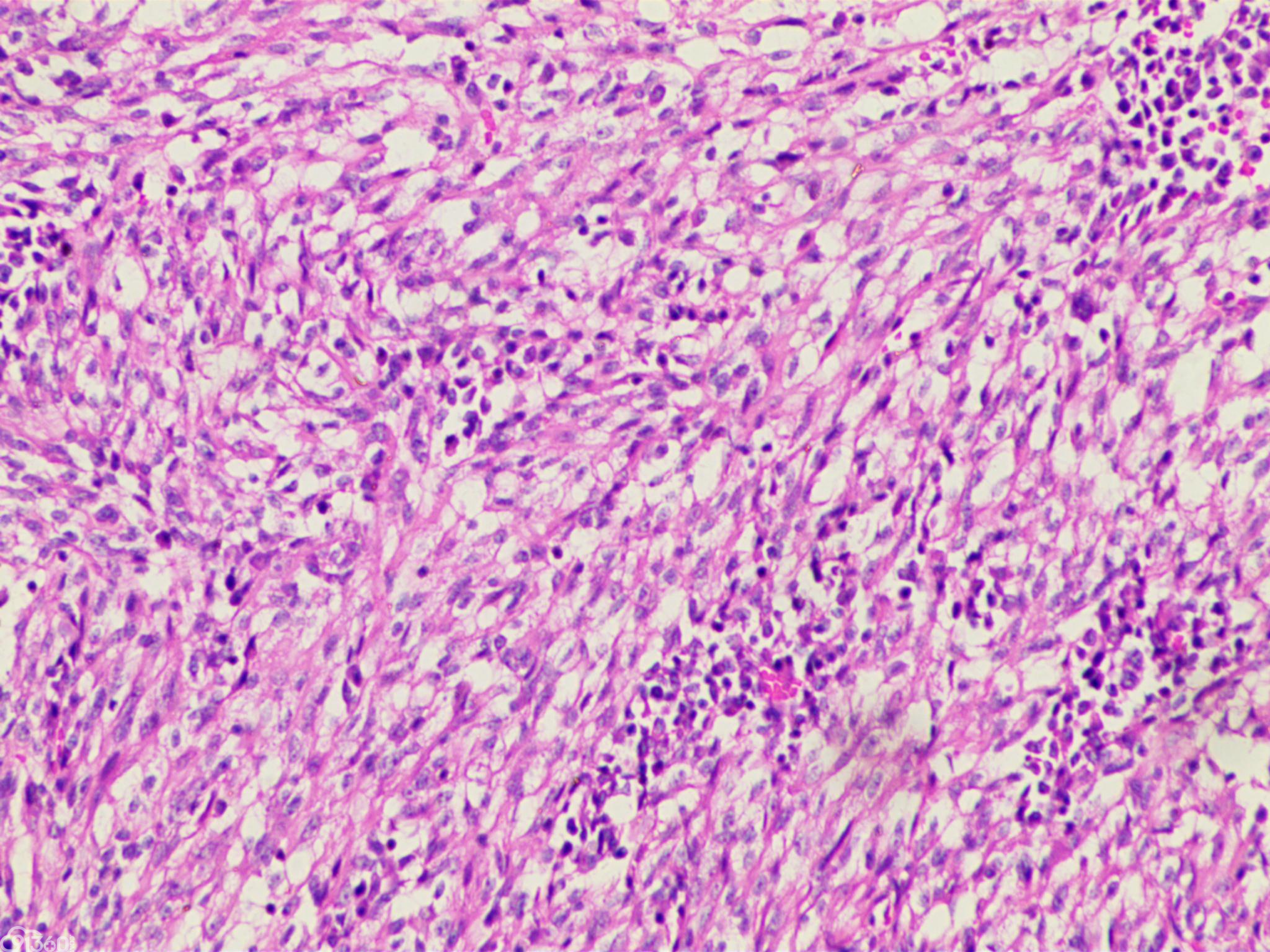 肾粘液小管梭形细胞癌