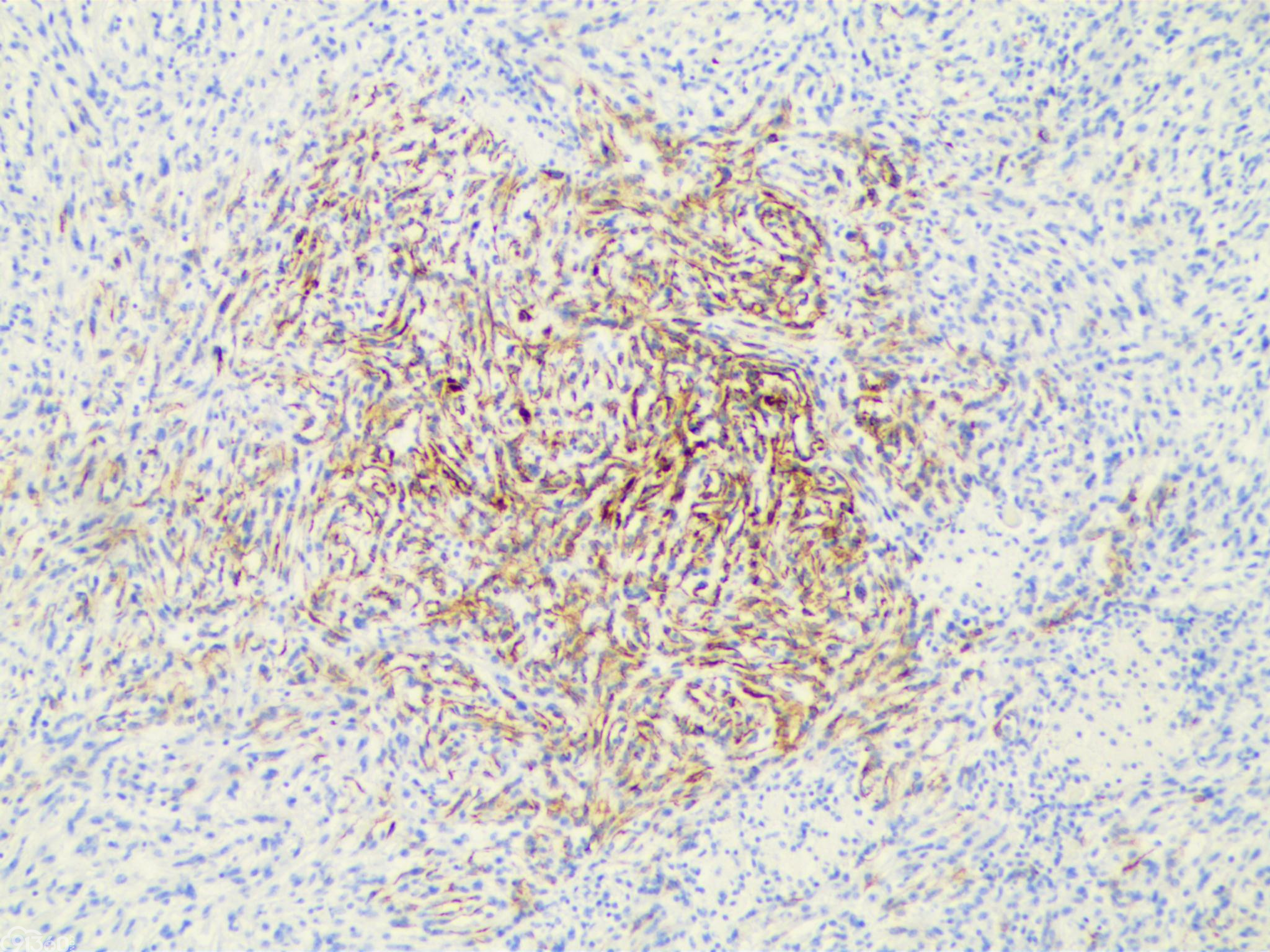 肾粘液小管梭形细胞癌