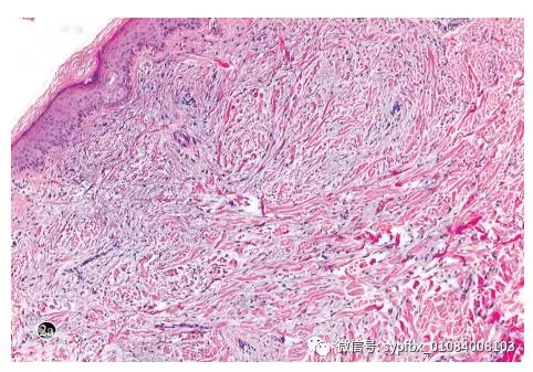 【病例报告】黏液水肿性苔藓一例