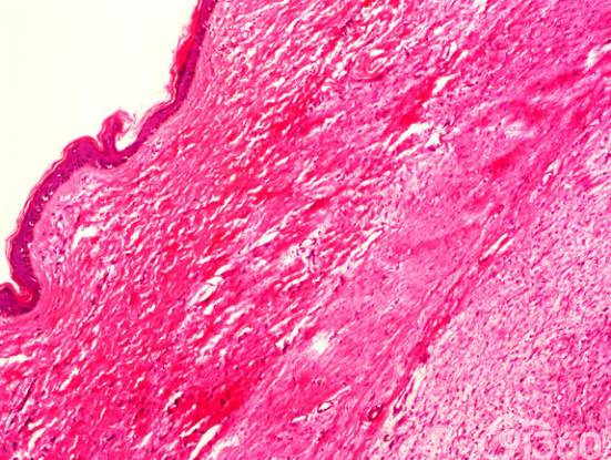 粘液样隆突性皮肤纤维肉瘤